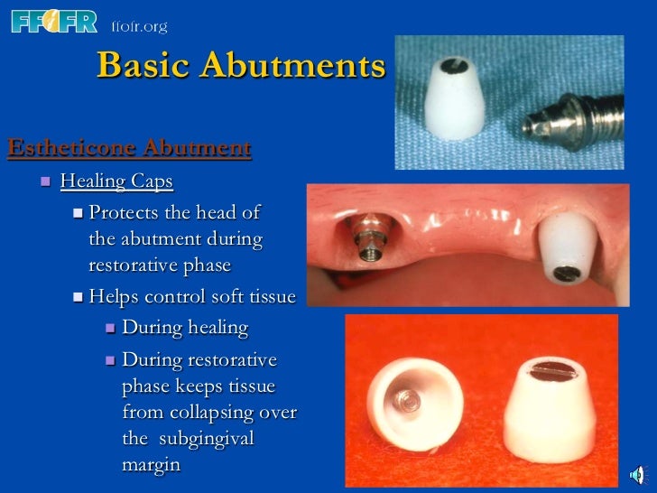 3.implant components and basic techniques3