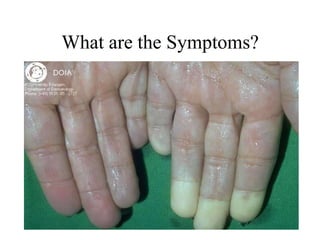 What are the Symptoms?
 