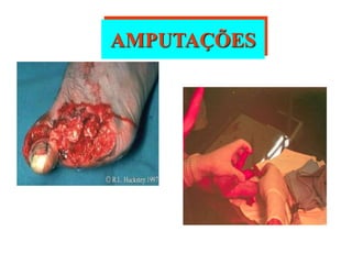 AMPUTAÇÕES
 