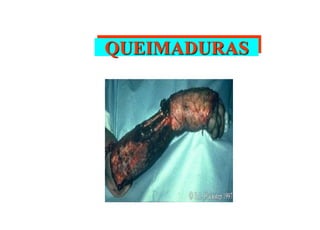 QUEIMADURAS
 