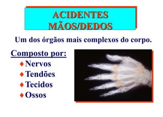 ACIDENTES
MÃOS/DEDOS
Um dos órgãos mais complexos do corpo.
Composto por:
Nervos
Tendões
Tecidos
Ossos
 