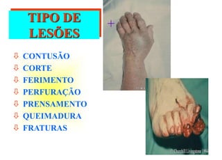  CONTUSÃO
 CORTE
 FERIMENTO
 PERFURAÇÃO
 PRENSAMENTO
 QUEIMADURA
 FRATURAS
TIPO DE
LESÕES
+
 