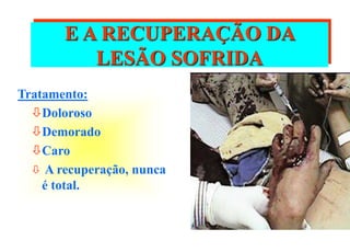 E A RECUPERAÇÃO DA
LESÃO SOFRIDA
Tratamento:
Doloroso
Demorado
Caro
 A recuperação, nunca
é total.
 