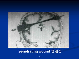 penetrating wound 贯通伤
111
 