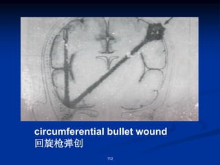 circumferential bullet wound
回旋枪弹创
112
 