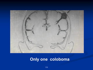 Only one coloboma
113
 