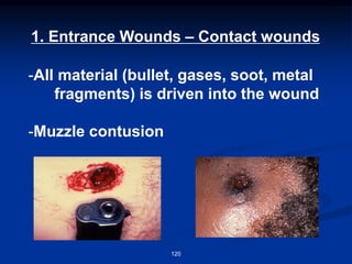 1. Entrance Wounds – Contact wounds
-All material (bullet, gases, soot, metal
fragments) is driven into the wound
-Muzzle contusion
120
 