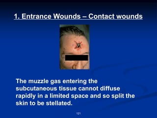 1. Entrance Wounds – Contact wounds
121
The muzzle gas entering the
subcutaneous tissue cannot diffuse
rapidly in a limited space and so split the
skin to be stellated.
 