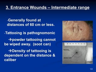 3. Entrance Wounds – Intermediate range
-Tattooing is pathognomonic
→powder tattooing cannot
be wiped away. (soot can)
→Density of tattooing is
dependent on the distance &
caliber
-Generally found at
distances of 60 cm or less.
123
 