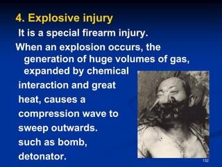 4. Explosive injury
It is a special firearm injury.
When an explosion occurs, the
generation of huge volumes of gas,
expanded by chemical
interaction and great
heat, causes a
compression wave to
sweep outwards.
such as bomb,
detonator. 132
 