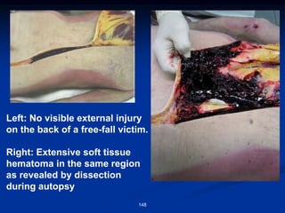 Left: No visible external injury
on the back of a free-fall victim.
Right: Extensive soft tissue
hematoma in the same region
as revealed by dissection
during autopsy
148
 