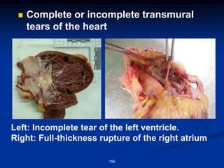 ◼ Complete or incomplete transmural
tears of the heart
Left: Incomplete tear of the left ventricle.
Right: Full-thickness rupture of the right atrium
156
 