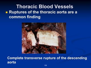 Thoracic Blood Vessels
◼ Ruptures of the thoracic aorta are a
common finding
158
Complete transverse rupture of the descending
aorta
 