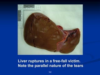 Liver ruptures in a free-fall victim.
Note the parallel nature of the tears
162
 