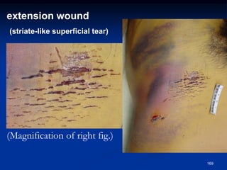 extension wound
(striate-like superficial tear)
(Magnification of right fig.)
169
 