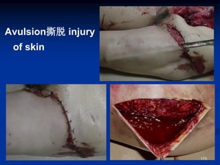 Avulsion撕脱 injury
of skin
173
 