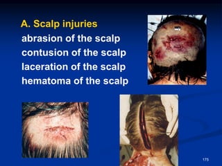 A. Scalp injuries
abrasion of the scalp
contusion of the scalp
laceration of the scalp
hematoma of the scalp
175
 