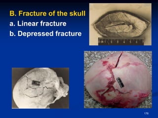 B. Fracture of the skull
a. Linear fracture
b. Depressed fracture
176
 