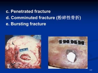 c. Penetrated fracture
d. Comminuted fracture (粉碎性骨折)
e. Bursting fracture
177
 