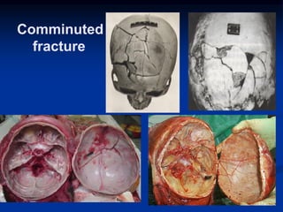 Comminuted
fracture
178
 