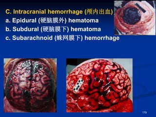 C. Intracranial hemorrhage (颅内出血)
a. Epidural (硬脑膜外) hematoma
b. Subdural (硬脑膜下) hematoma
c. Subarachnoid (蛛网膜下) hemorrhage
179
 