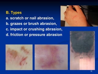 B. Types
a. scratch or nail abrasion,
b. grazes or brush abrasion,
c. impact or crushing abrasion,
d. friction or pressure abrasion
18
 