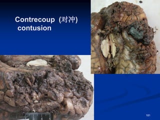 Contrecoup (对冲)
contusion
181
 