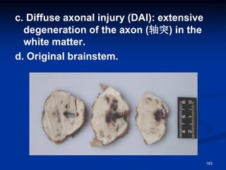 c. Diffuse axonal injury (DAI): extensive
degeneration of the axon (轴突) in the
white matter.
d. Original brainstem.
183
 