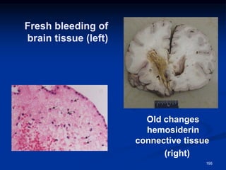 Fresh bleeding of
brain tissue (left)
Old changes
with hemosiderin
and connective tissue
(right)
195
 