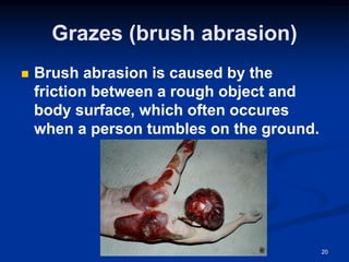 Grazes (brush abrasion)
◼ Brush abrasion is caused by the
friction between a rough object and
body surface, which often occures
when a person tumbles on the ground.
20
 