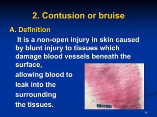 2. Contusion or bruise
A. Definition
It is a non-open injury in skin caused
by blunt injury to tissues which
damage blood vessels beneath the
surface,
allowing blood to
leak into the
surrounding
the tissues.
24
 