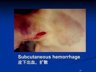 Subcutaneous hemorrhage
皮下出血，扩散
27
 