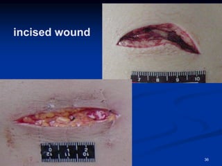 incised wound
36
 