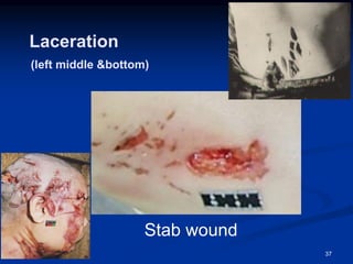 Laceration
(left middle &bottom)
Stab wound
37
 