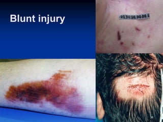 Blunt injury
38
 