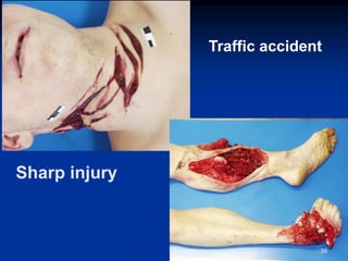 Sharp injury
39
Traffic accident
 