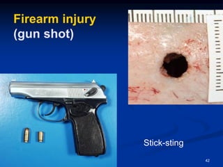 Firearm injury
(gun shot)
42
Stick-sting
 