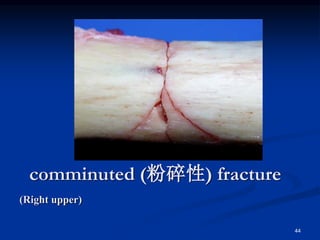 comminuted (粉碎性) fracture
(Right upper)
44
 
