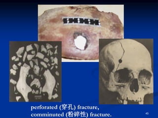 45
perforated (穿孔) fracture,
comminuted (粉碎性) fracture.
 