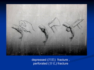 depressed (凹陷) fracture ,
perforated (穿孔) fracture
 