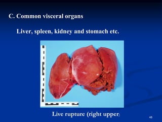 C. Common visceral organs
Liver, spleen, kidney and stomach etc.
48
Live rupture (right upper)
 