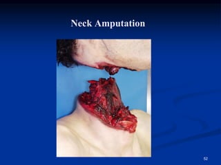 Neck Amputation
52
 