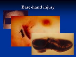 Bare-hand injury
57
 