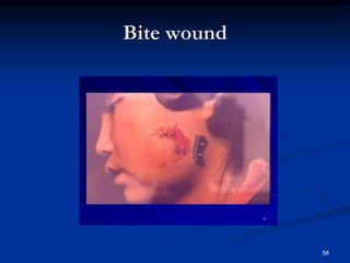 Bite wound
58
 