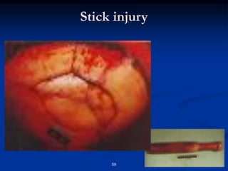 59
Stick injury
 