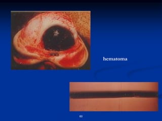 60
hematoma
 