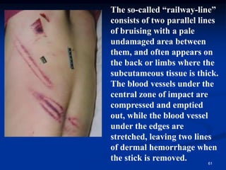 61
The so-called “railway-line”
consists of two parallel lines
of bruising with a pale
undamaged area between
them, and often appears on
the back or limbs where the
subcutameous tissue is thick.
The blood vessels under the
central zone of impact are
compressed and emptied
out, while the blood vessel
under the edges are
stretched, leaving two lines
of dermal hemorrhage when
the stick is removed.
 