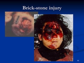 Brick-stone injury
62
 