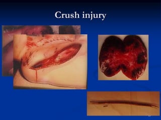 Crush injury
67
 