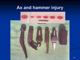 Ax and hammer injury
68
 